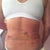 Back view, hunched over still.  You can see all the bruising from lipo.