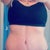 12 week post op