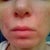 6 month and 21 day after ePrime (redness, brown spots, scars and noticeable wrinkles around the mouth, my face is shifting on left side)