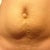 That ugly button bellybutton you see is my hernia. I am getting that and muscle repair. If I stand up a bit straighter you can see the center of my stomach has a large dent. Which I can't stand makes my stomach look weird. I never had this before pregnancy. The abdominal walls as well, are too separated due to a large almost 9lb baby.
