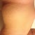 Left side stretch marks unfortunately, not all can be removed unless the scar is higher. In that case I'll stick to a lower scar with stretch marks i guess. Hey life can't be perfect huh? We'll see....