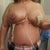 2 days post op
