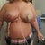 2 days post op... I feel like such an A cup!