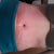 3 weeks PO the little wrinkles in the skin above my underwear is because of the tape.