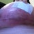 There is my infected boob about 2 hrs before it slpit open, you can kinda see the grren stuff thats were it came open and it all came out