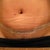 17 days post op