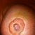 Kinda gross close up of healing nipple... It was misshapen for awhile, it does get better!