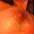 And more healing.... The dark spots that look like scabs are actually the glue.