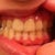 Hate my lighting; it makes me teeth look yellow when they are not that colour lol Here is an updated shot on my teeth with my bite closed. They still look pretty messed. I need to remind my Orthodontist to shave the bottoms of my top front teeth so they're not uneven.