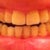 Bite open; looks worse in this picture than in person, but still pretty crooked and uneven.