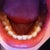 Bottom teeth; I do see a tiny bit of improvement, compared to the first picture I posted.