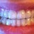 Tray #4 on my teeth