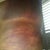 Left side 1 day post