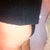 This is 10+ weeks and I feel back to normal.  Skin feels together and swelling long gone.  I think there is some flash in this picture but it was the bottom of the butt that was the very worst anyway.