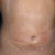 Front Less than 24hrs Day After Still Swollen 
