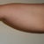 Arm before Vaser 