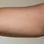 Arm Day 2 Still Swollen 