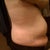 Day 11- so swollen! This picture has been posted to ease other peoples' minds that- yes it's true- you do swell up like no other during the recovery.