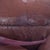 Close up of incision and drains.