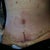 post op day 3.