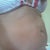 preop side view
