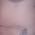 12 weeks 1 day My Hourglass is coming back nicely and I have a few bumps from the underlying stitches but it will get better