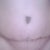 My scar is not going away as fast as most of yours but I know it will I just stopped looking at the scar for a while now.