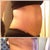 Before after right side