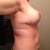 3days post op