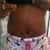 front view of my stomach 20 days post tt, my stretch marks are improving constantly. I have been using maderma, palmers scar/stretch mark oil and a scar treatment with silicone it everyday.