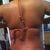 back view of liposuction areas