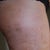 close up right lateral thigh