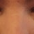 Dec15botheyes. Very bad swelling