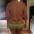Back view of my back before surgery