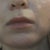 1 year and 10 days after ePrime: scars, brown spots, discoloration, sagging skin under the jowls and my face is still shifting on left side.