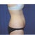 Before SmartLipo