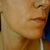 day 3 or 4 you can see contrast between old brown skin and new soft skin beneath.