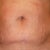 Look closely at the pic. See the string by my button? I thought the DR stitched it. I pulled it and fluid came out, so I left it alone until the next day at my follow up. It was a piece of fat, the Dr pulled it out!