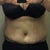 5 days post op