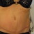 4 months PO in same bikini with scar exposed