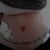 5 days after surgery