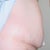 Before surgery picture