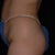 Side View Before with upper thigh