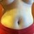 5 days post op