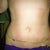 3 weeks post op: Front view with scar