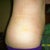 Side view 3 weeks post-op