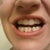 Aligners 15 - you can see the gaps now that the pontics are gone.