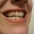 15 - Right side. not sure why my canine looks so discolored, it doesnt look that way without the aligner in.