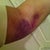 post op day 1, My arm right after surgery, it was bruised badly for about a month afterwards, its gone now!