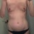 Before Surgery - 34AA